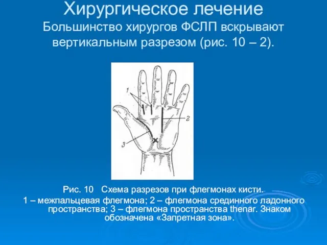 Хирургическое лечение Большинство хирургов ФСЛП вскрывают вертикальным разрезом (рис. 10