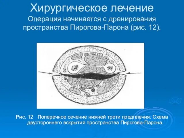 Хирургическое лечение Операция начинается с дренирования пространства Пирогова-Парона (рис. 12).