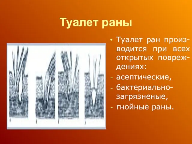 Туалет раны Туалет ран произ-водится при всех открытых повреж-дениях: асептические, бактериально- загрязненые, гнойные раны.