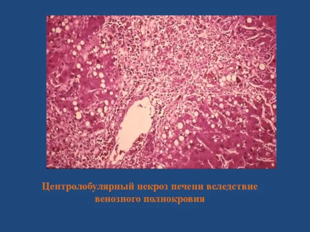 Центролобулярный некроз печени вследствие венозного полнокровия
