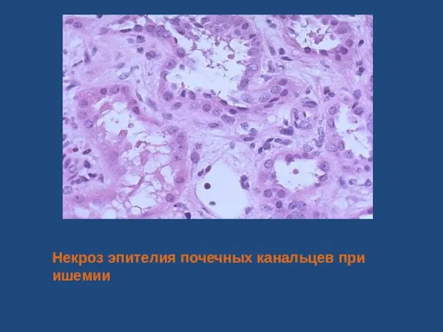 Некроз эпителия почечных канальцев при ишемии