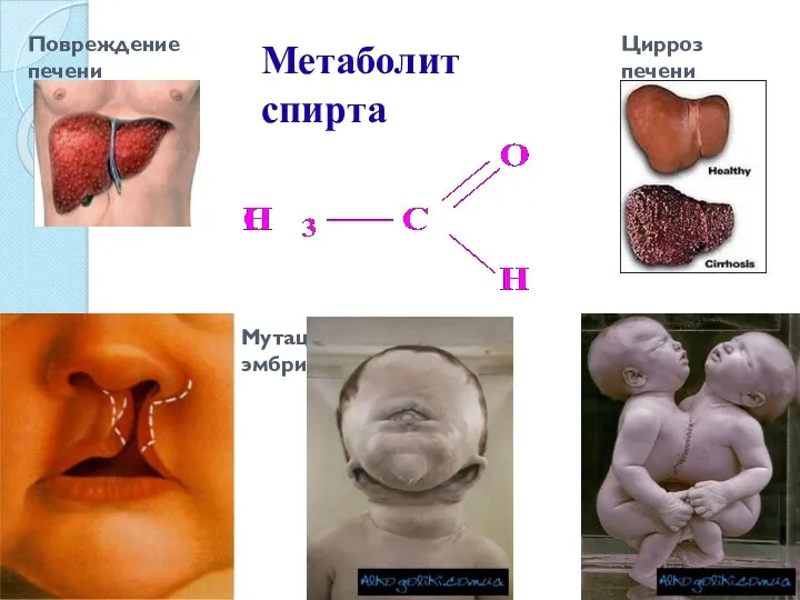 Метаболит спирта Повреждение печени Цирроз печени Мутации и уродства эмбрионов