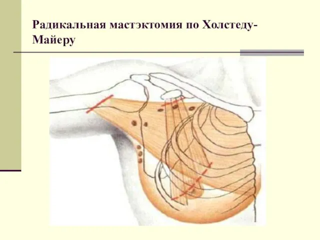 Радикальная мастэктомия по Холстеду-Майеру