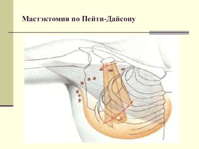 Мастэктомия по Пейти-Дайсону