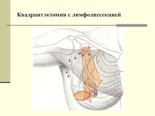 Квадрантэктомия с лимфодиссекцией