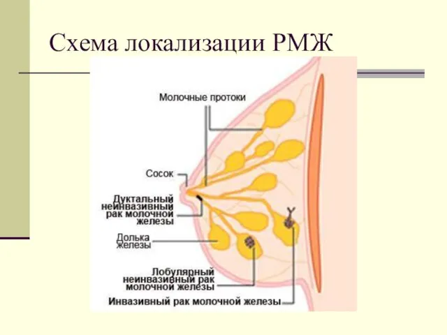 Схема локализации РМЖ