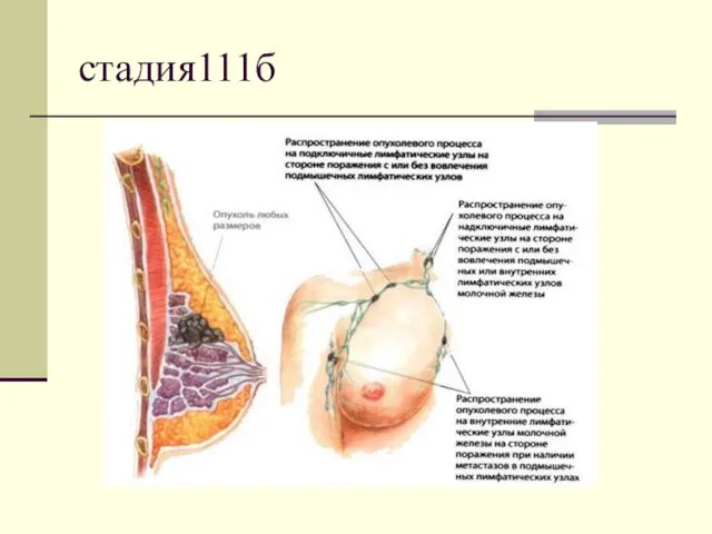 стадия111б