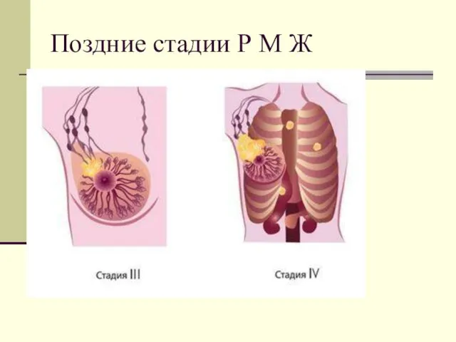 Поздние стадии Р М Ж