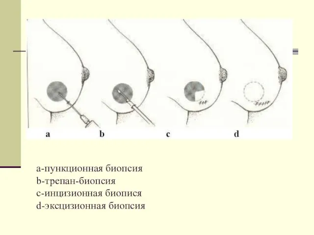 a-пункционная биопсия b-трепан-биопсия c-инцизионная биопися d-эксцизионная биопсия