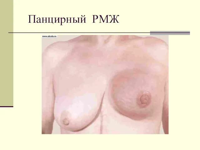 Панцирный РМЖ