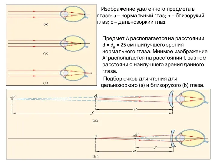 Изображение удаленного предмета в глазе: a – нормальный глаз; b