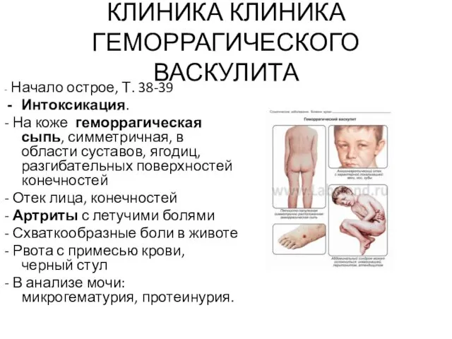 КЛИНИКА КЛИНИКА ГЕМОРРАГИЧЕСКОГО ВАСКУЛИТА - Начало острое, Т. 38-39 Интоксикация.