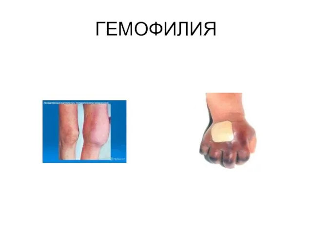 ГЕМОФИЛИЯ