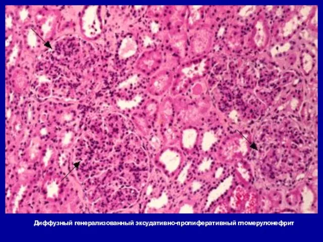 Диффузный генерализованный эксудативно-пролиферативный гломерулонефрит