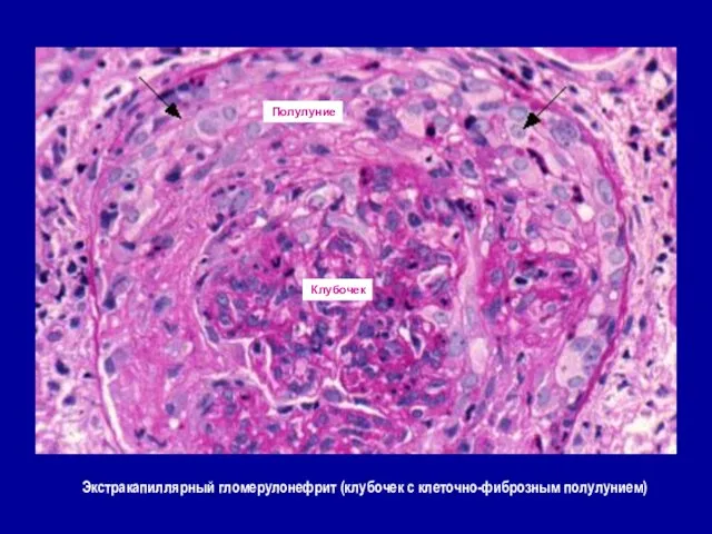 Экстракапиллярный гломерулонефрит (клубочек с клеточно-фиброзным полулунием) Клубочек Полулуние