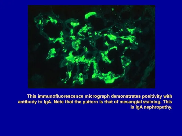 This immunofluorescence micrograph demonstrates positivity with antibody to IgA. Note that the pattern