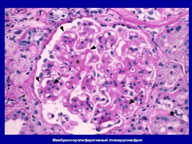 Мембрано-пролиферативный гломерулонефрит