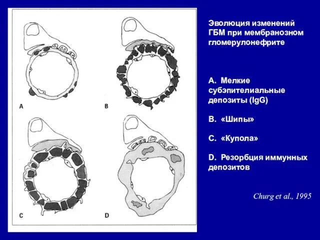Эволюция изменений ГБМ при мембранозном гломерулонефрите А. Мелкие субэпителиальные депозиты (IgG) В. «Шипы»