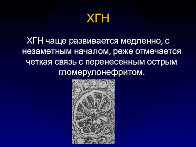 ХГН ХГН чаще развивается медленно, с незаметным началом, реже отмечается четкая связь с перенесенным острым гломерулонефритом.