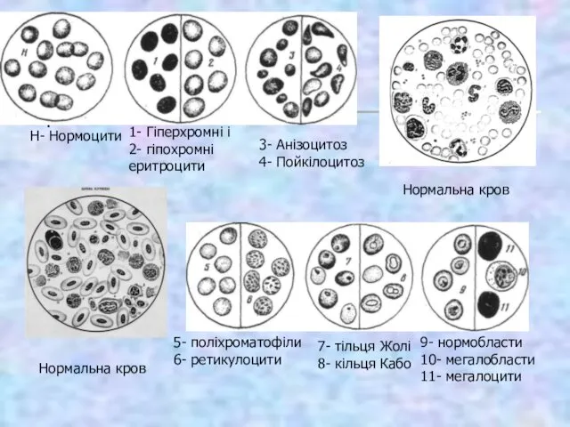 Н- Нормоцити 1- Гіперхромні і 2- гіпохромні еритроцити 3- Анізоцитоз 4- Пойкілоцитоз Нормальна