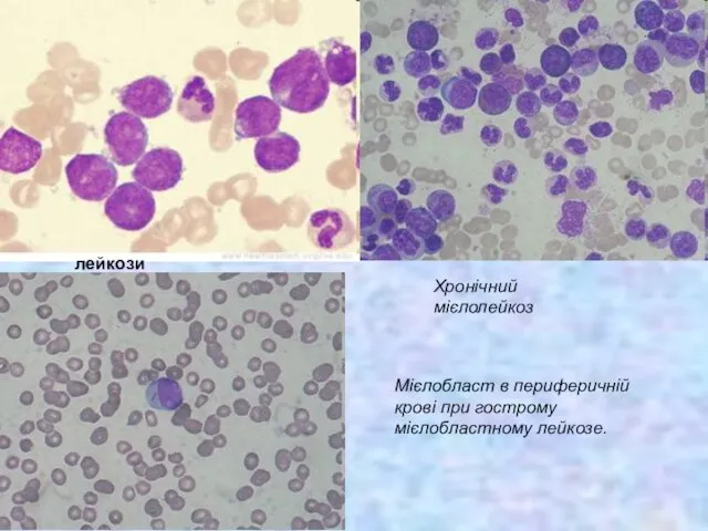 лейкози Хронічний мієлолейкоз Мієлобласт в периферичній крові при гострому мієлобластному лейкозе.