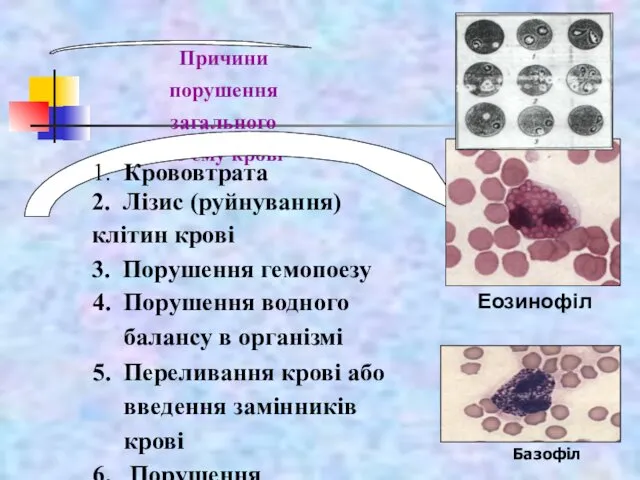 Причини порушення загального об'єму крові 1. Крововтрата 2. Лізис (руйнування) клітин крові 3.