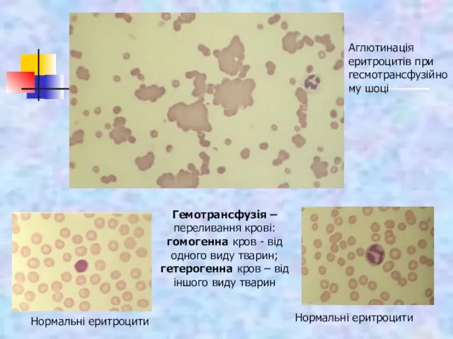 Аглютинація еритроцитів при гесмотрансфузійному шоці Нормальні еритроцити Гемотрансфузія – переливання