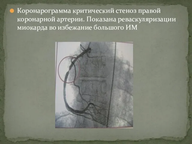 Коронарограмма критический стеноз правой коронарной артерии. Показана реваскуляризации миокарда во избежание большого ИМ