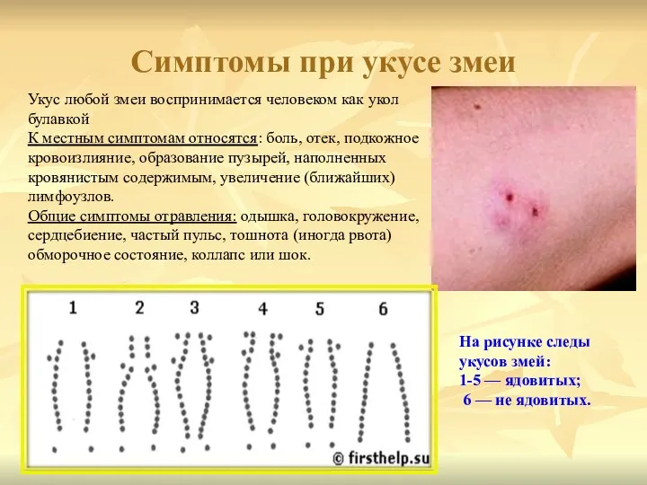 Симптомы при укусе змеи Укус любой змеи воспринимается человеком как