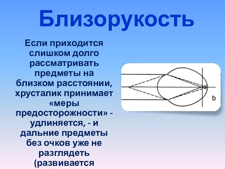 Близорукость Если приходится слишком долго рассматривать предметы на близком расстоянии,