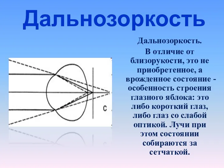 Дальнозоркость Дальнозоркость. В отличие от близорукости, это не приобретенное, а