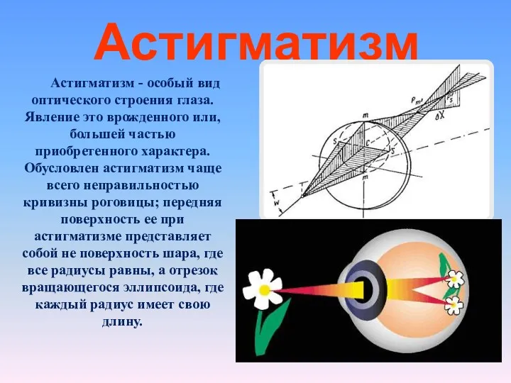 Астигматизм Астигматизм - особый вид оптического строения глаза. Явление это