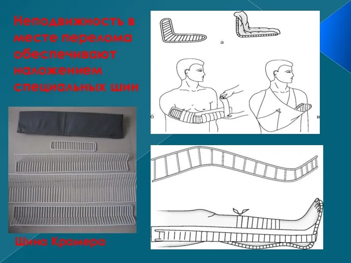 Неподвижность в месте перелома обеспечивают наложением специальных шин Шина Крамера