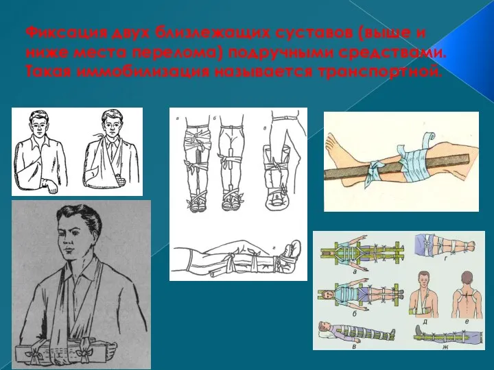 Фиксация двух близлежащих суставов (выше и ниже места перелома) подручными средствами. Такая иммобилизация называется транспортной.