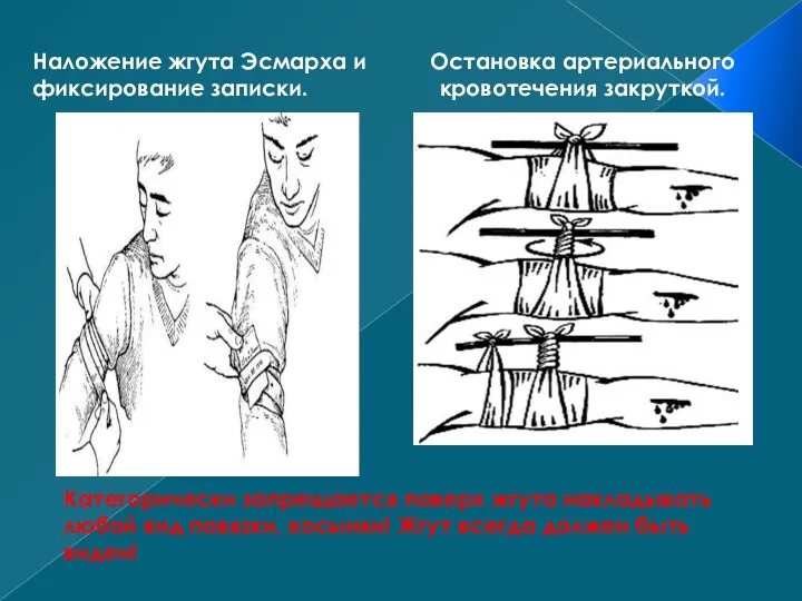 Категорически запрещается поверх жгута накладывать любой вид повязки, косынки! Жгут