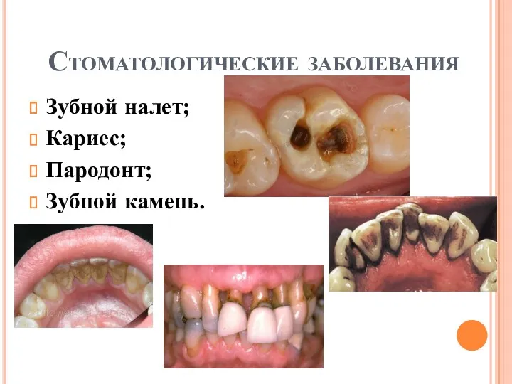 Стоматологические заболевания Зубной налет; Кариес; Пародонт; Зубной камень.