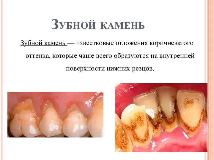 Зубной камень Зубной камень — известковые отложения коричневатого оттенка, которые