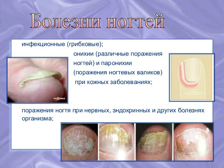 инфекционные (грибковые); онихии (различные поражения ногтей) и паронихии (поражения ногтевых
