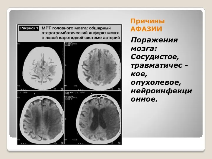 Причины АФАЗИИ Поражения мозга: Сосудистое, травматичес - кое, опухолевое, нейроинфекционное.