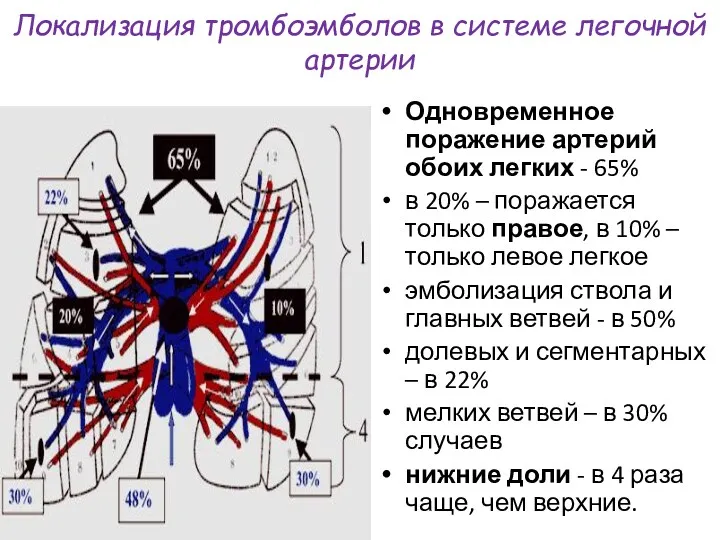 Локализация тромбоэмболов в системе легочной артерии Одновременное поражение артерий обоих