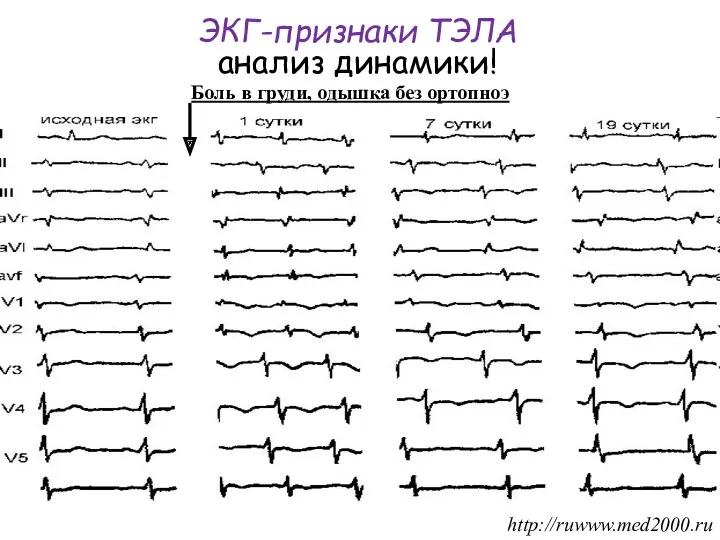 Боль в груди, одышка без ортопноэ ЭКГ-признаки ТЭЛА анализ динамики! http://ruwww.med2000.ru