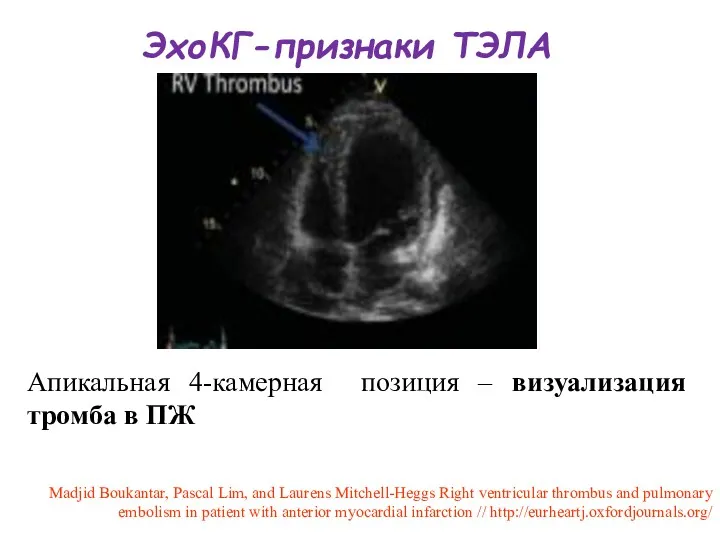 ЭхоКГ-признаки ТЭЛА Апикальная 4-камерная позиция – визуализация тромба в ПЖ