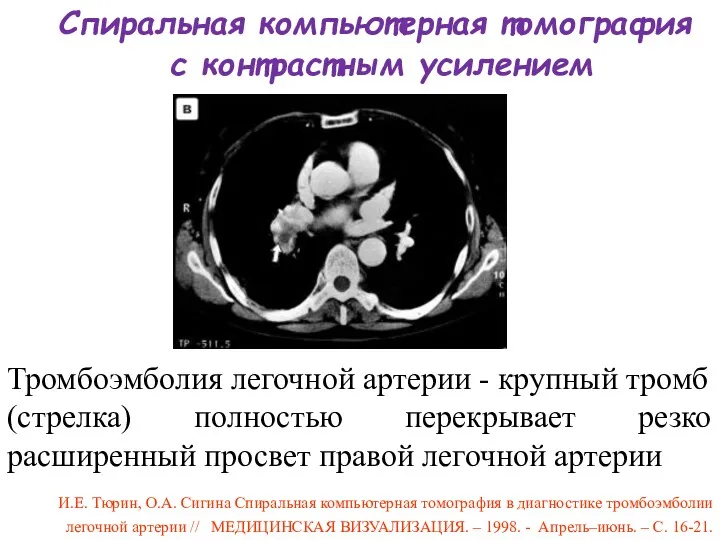 Спиральная компьютерная томография с контрастным усилением Тромбоэмболия легочной артерии -