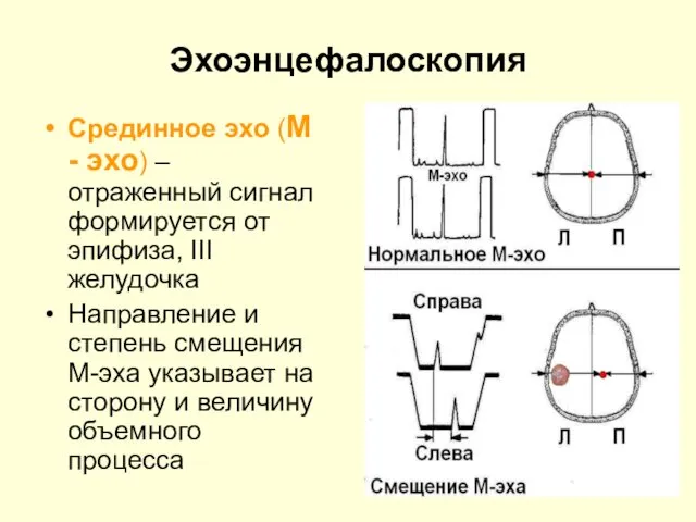 Эхоэнцефалоскопия Срединное эхо (М - эхо) – отраженный сигнал формируется