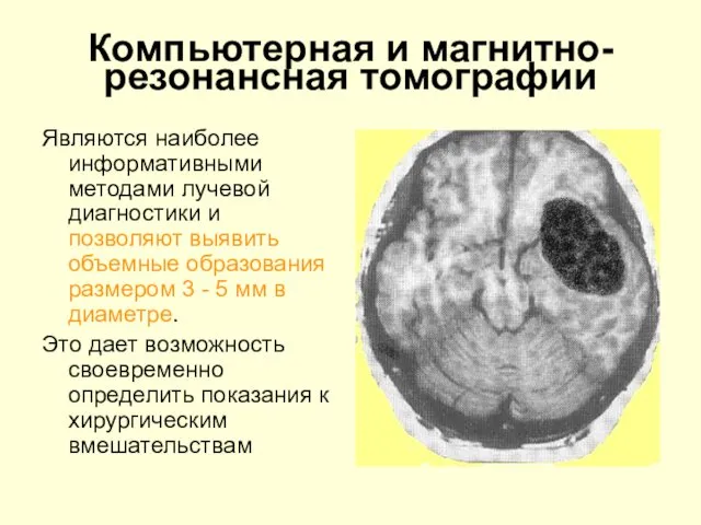 Компьютерная и магнитно-резонансная томографии Являются наиболее информативными методами лучевой диагностики