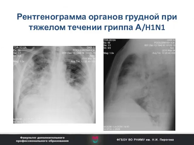 Рентгенограмма органов грудной при тяжелом течении гриппа А/H1N1