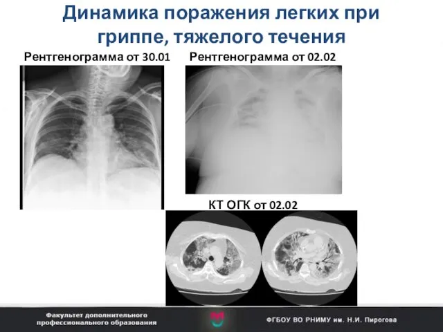 Динамика поражения легких при гриппе, тяжелого течения Рентгенограмма от 30.01