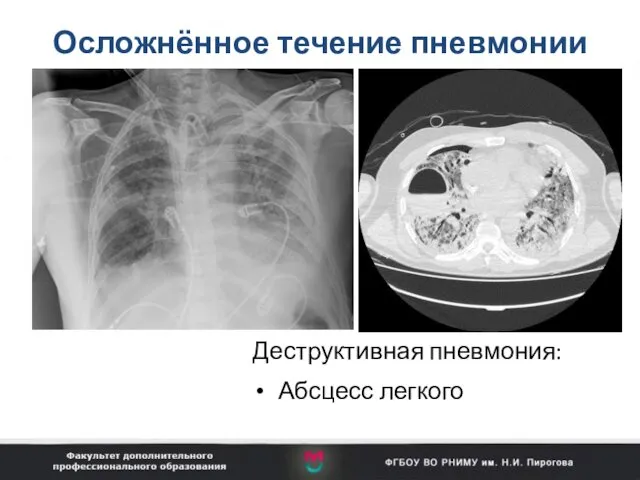 Осложнённое течение пневмонии Деструктивная пневмония: Абсцесс легкого