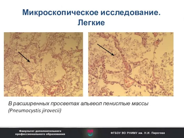 Микроскопическое исследование. Легкие В расширенных просветах альвеол пенистые массы (Pneumocystis jirovecii)