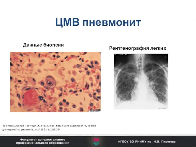 ЦМВ пневмонит Данные биопсии Рентгенография легких Salomon N, Gomez T,